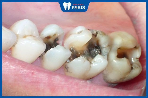 Bác sĩ cần điều trị tủy trong trường hợp răng sâu nặng