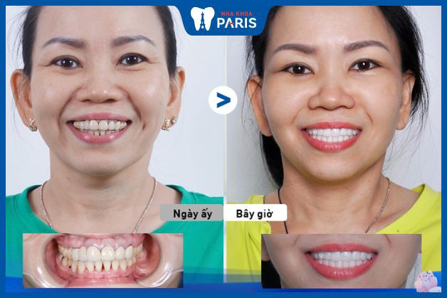 Nha Khoa Paris khắc phục thành công răng sứ bị hỏng