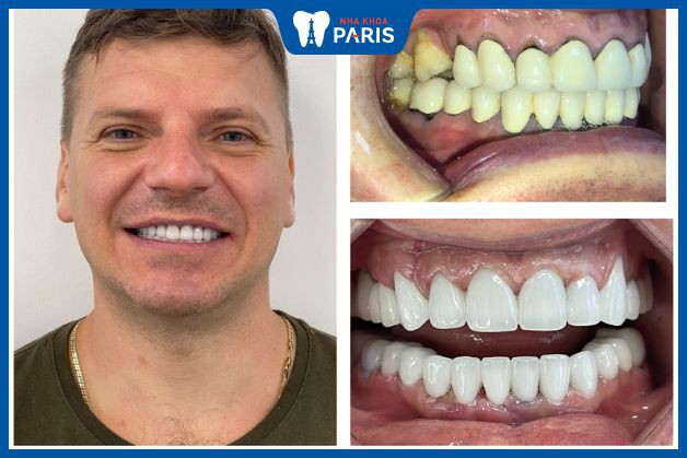 Khách hàng sửa răng cũ bị hỏng tại Nha Khoa Paris