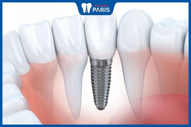 Cấy ghép răng Implant là phương pháp trồng răng giả toàn diện