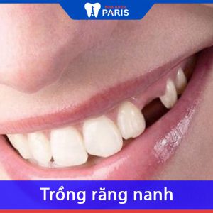 Trồng răng nanh: Chi phí, phương pháp và quy trình thực hiện