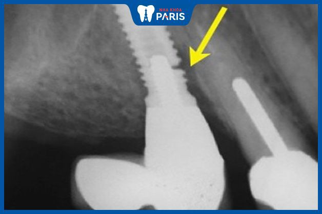 Trụ Implant bị lung lay do gãy