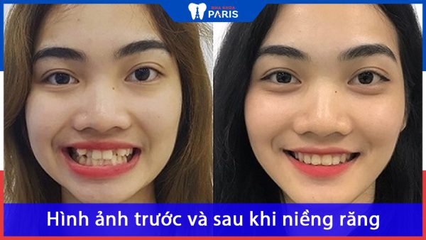 Hình ảnh trước và sau khi niềng răng: Sự khác biệt rõ rệt