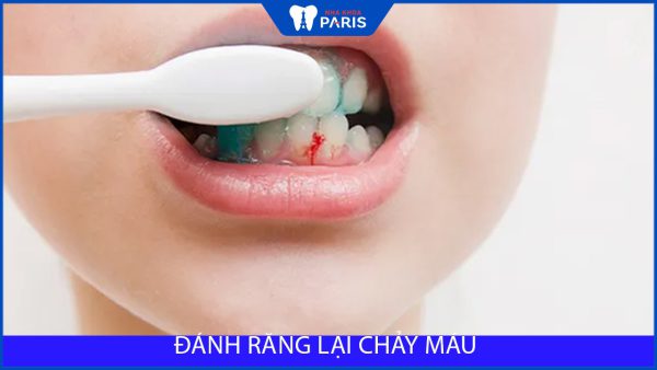 Đánh răng bị chảy máu: Nguyên nhân và cách điều trị