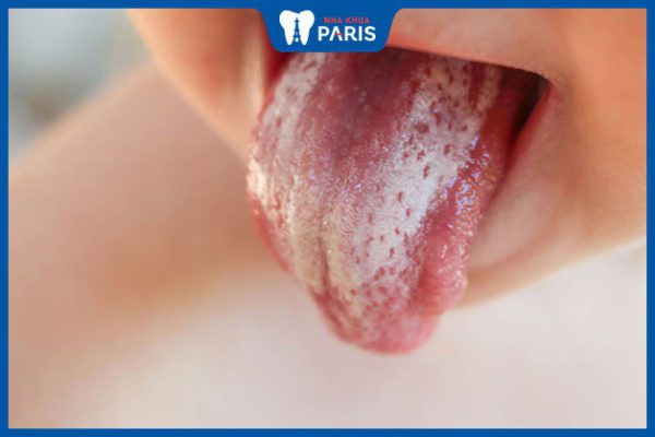 Nấm lưỡi ở trẻ: Triệu chứng, nguyên nhân và cách điều trị