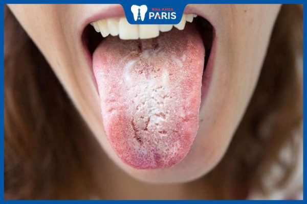 Nấm miệng là gì? Nguyên nhân, chẩn đoán và cách điều trị