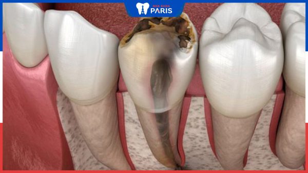 Viêm tủy răng: Nguyên nhân, dấu hiệu và các phương pháp điều trị