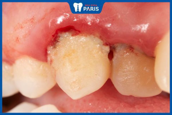 Sưng nướu răng: Nguyên nhân, tác hại và cách điều trị