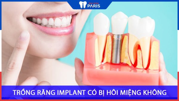 Trồng răng Implant có bị hôi miệng không – Nha khoa pairs