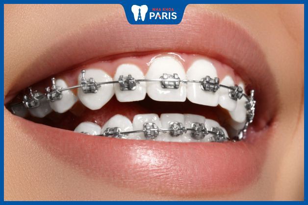 Niềng răng không làm giảm tuổi thọ của răng