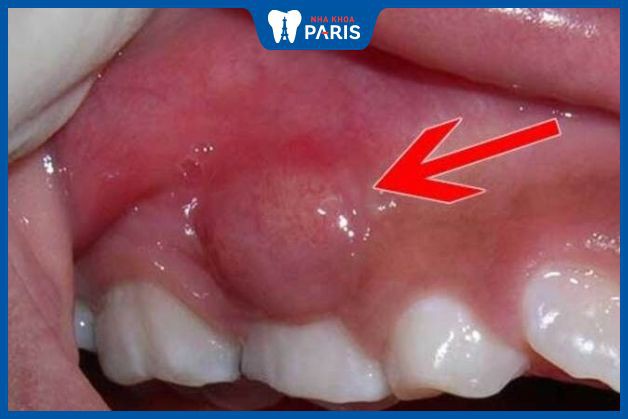 Áp xe răng là kết quả của nhiễm trùng chân răng