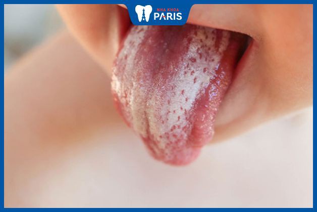 Bệnh nấm lưỡi có thể xảy ra ở mọi độ tuổi