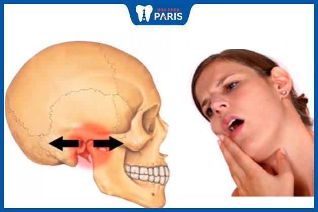 Bị đau hàm dưới bên phải do viêm khớp thái dương hàm
