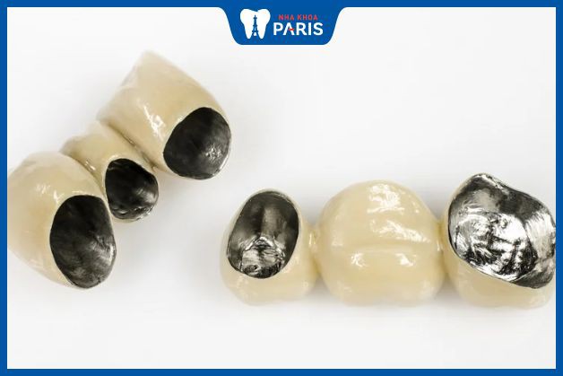 Các loại răng sứ phổ biến - Răng sứ kim loại thường