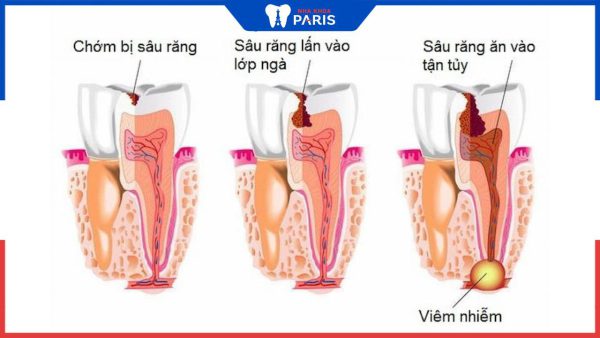 Các mức độ sâu răng và 4 phương pháp điều trị hiệu quả nhất