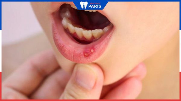 Cách chữa viêm loét miệng ở trẻ em cực hiệu quả