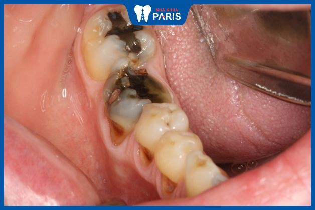 Bệnh lý răng miệng gây đau nhức quai hàm