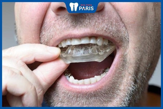 Mẹo chữa nghiến răng ban đêm - Dùng máng chống nghiến răng