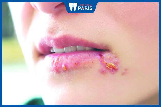Herpes môi là gì