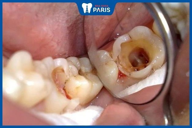 Răng sâu lộ tủy cần tiến hành điều trị tủy