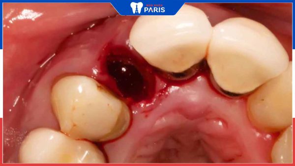 Lỗ hổng sau khi nhổ răng có nguy hiểm không?