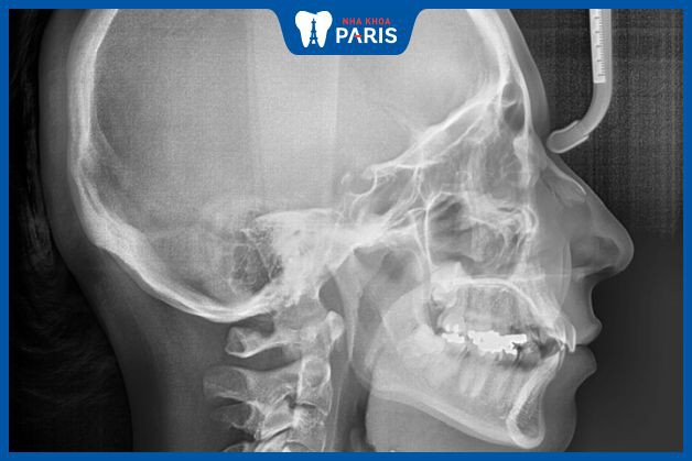 Phim chụp X-quang giúp bác sĩ xác định chính xác bệnh lý ở khớp thái dương hàm