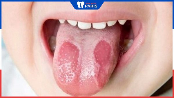 Mảng trắng trong miệng sau khi đánh răng là gì? Cách điều trị