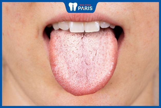 mảng trắng có trong miệng sau khi đánh răng
