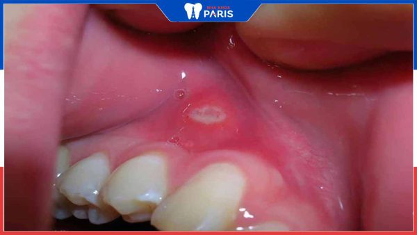 Nổi đẹn ở nướu răng: Nguyên nhân, triệu chứng và cách xử lý