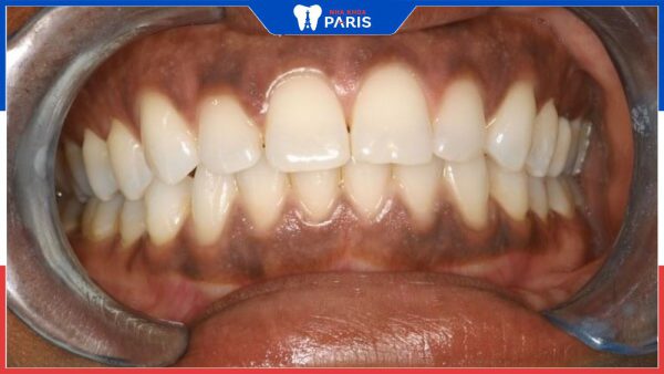 Nướu răng bị đen: Nguyên nhân, cách khắc phục và phòng tránh