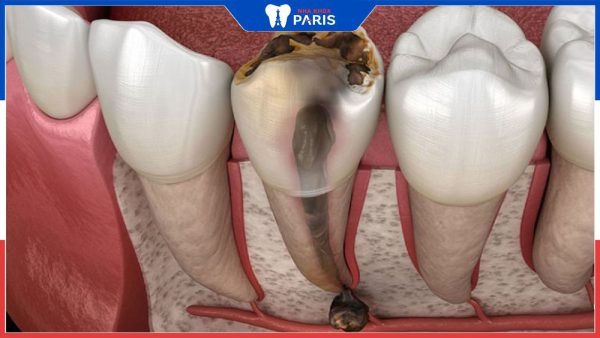 Răng chết tủy: Nguyên nhân, dấu hiệu, cách điều trị