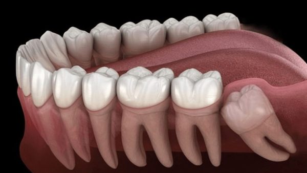Răng khôn là răng số mấy – Những trường hợp nên nhổ bỏ