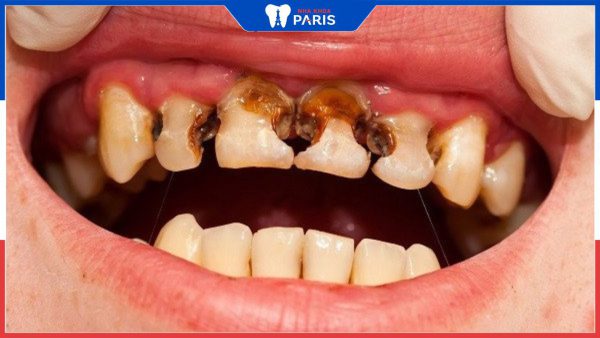 Sâu kẽ răng cửa xảy ra do đâu? Biện pháp chữa trị hiệu quả