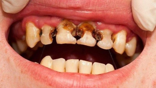 Sâu răng cửa: Nguyên nhân, triệu chứng và cách điều trị