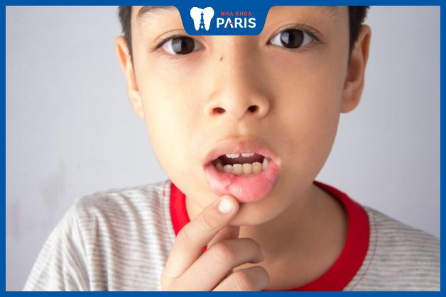 Tại sao nhiệt miệng thường xảy ra ở trẻ em