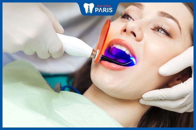 Tẩy trắng răng tại nha khoa - An toàn, chuyên nghiệp