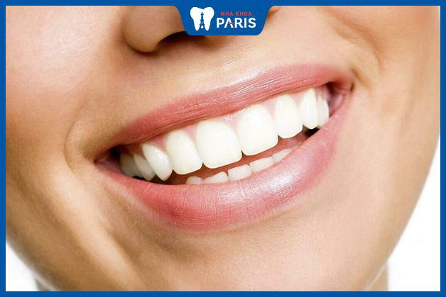 Opalescence giúp hàm răng trắng tự nhiên