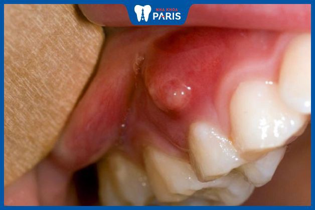 Triệu chứng khi bị viêm chân răng có mủ