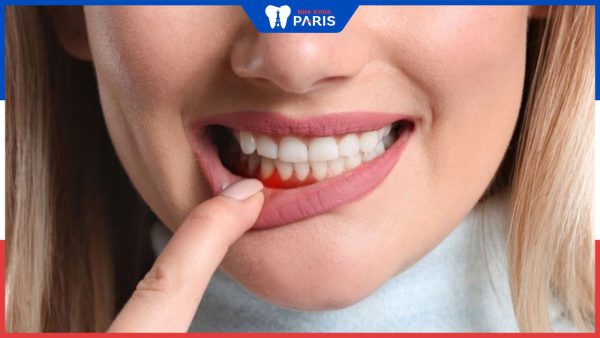 Bị áp xe răng kiêng ăn gì để nhanh chóng hồi phục?