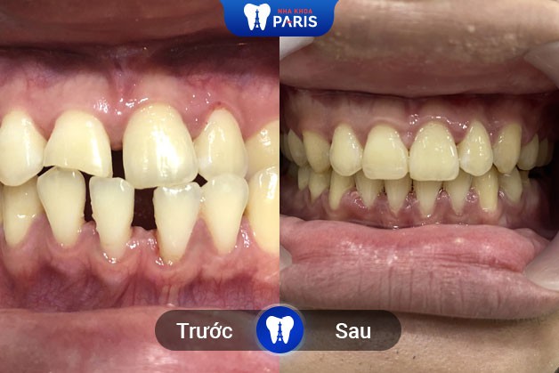 Hình ảnh trước và sau khi niềng răng tại Nha Khoa Paris