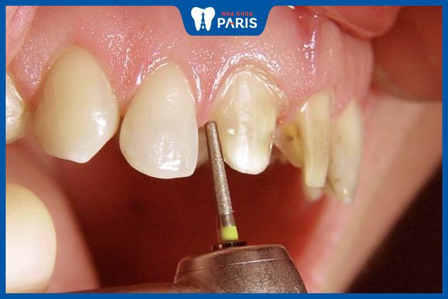Bác sĩ mài răng sai kỹ thuật có thể làm hở chân răng