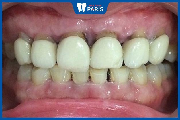 Hở cổ chân răng làm tăng nguy cơ hỏng cùi răng thật bên trong