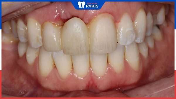 Bọc răng sứ phần chân răng bị hở do đâu – Phương án khắc phục