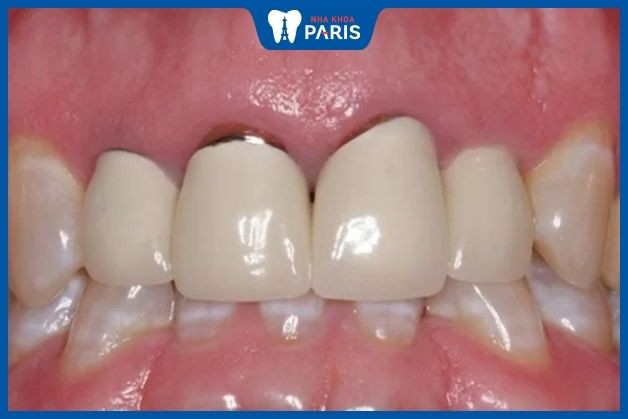 Hở chân răng sứ là rủi ro dễ gặp phải khi làm răng sứ giá rẻ