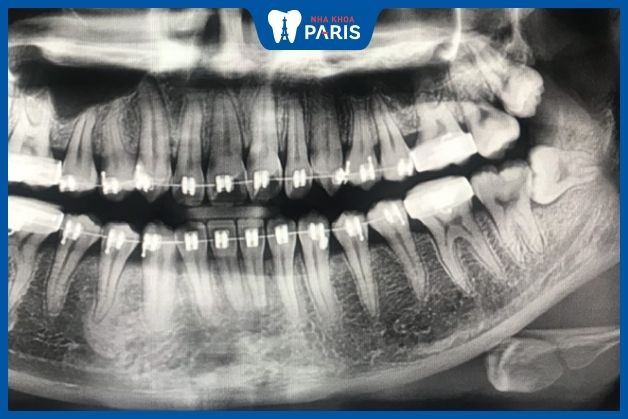 Chụp CT trước khi nhổ răng khôn