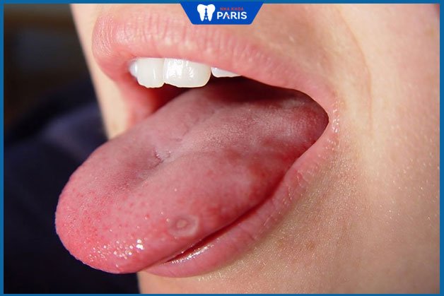 Hình ảnh lưỡi bị bệnh viêm loét