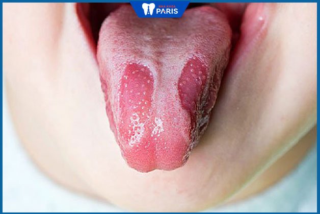 Hình ảnh lưỡi bị bệnh viêm lưỡi bản đồ