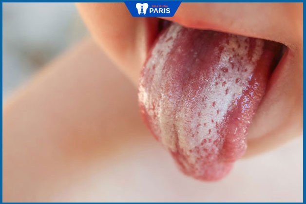 Hình ảnh lưỡi bị bệnh lưỡi trắng