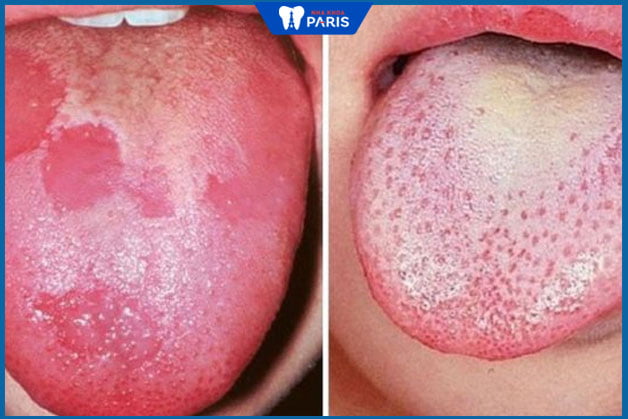 Hình ảnh lưỡi bị bệnh bạch sản