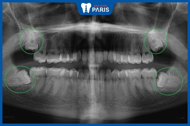 Hình ảnh X-quang răng khôn mọc dưới nướu